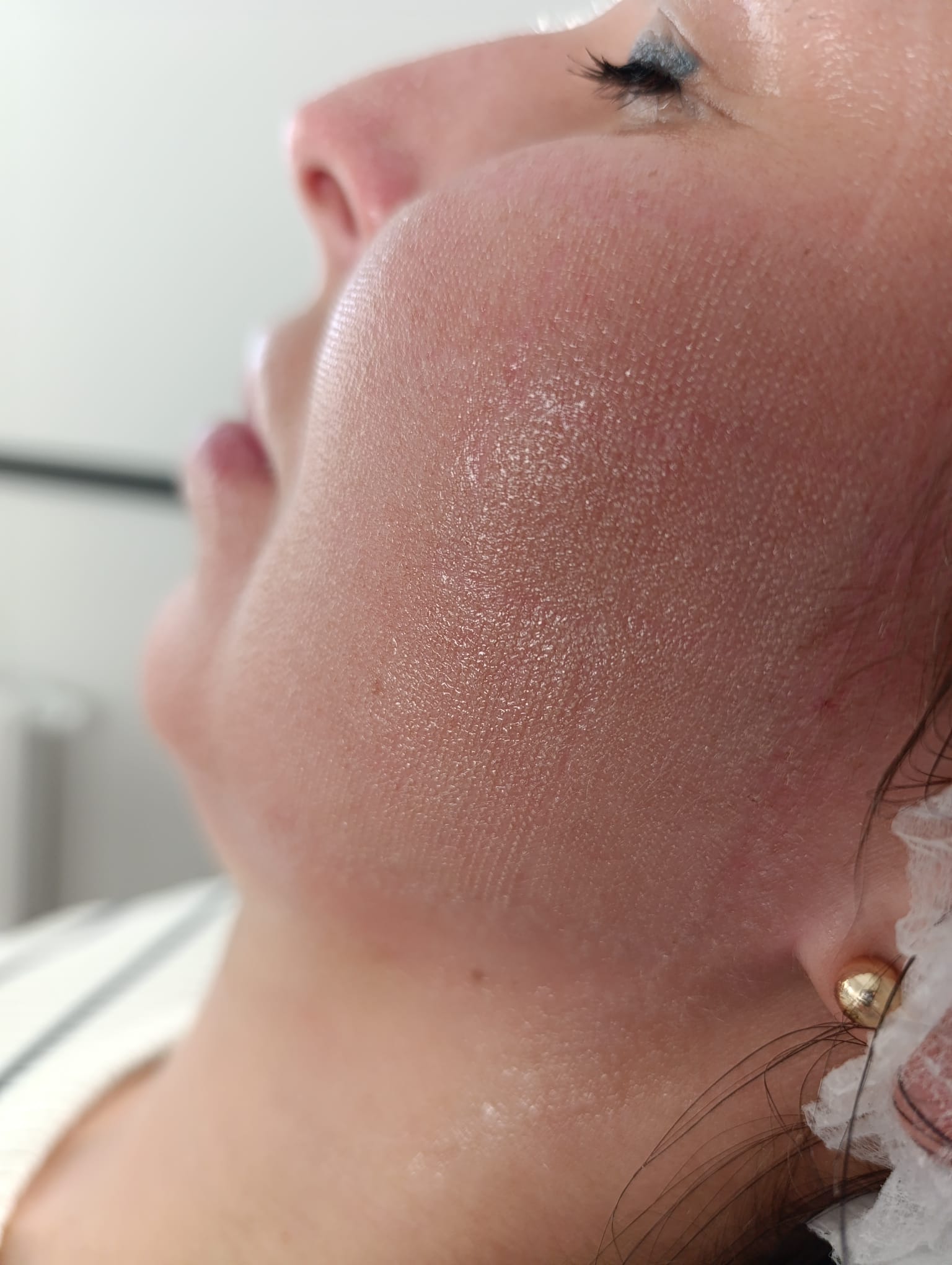 Laser Frakcyjny usuwanie zmian Elbląg