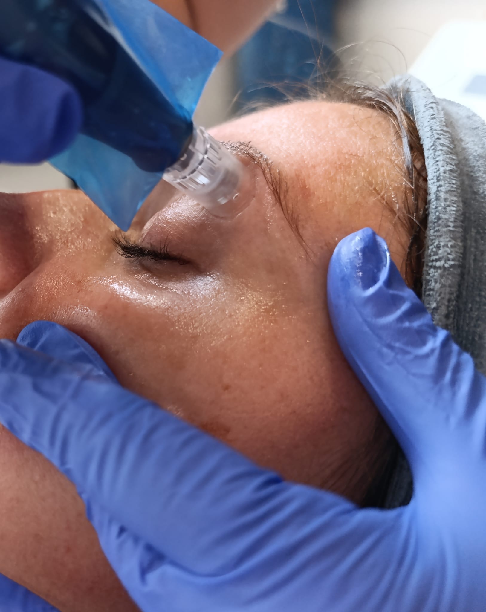 pro-pen-dermalogica-mikronakluwanie-elblag